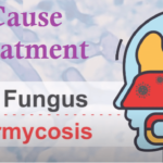 Do You Know Black Fungus Is Infecting Many Of India's COVID-19 Patients?