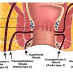 best fistula treatment