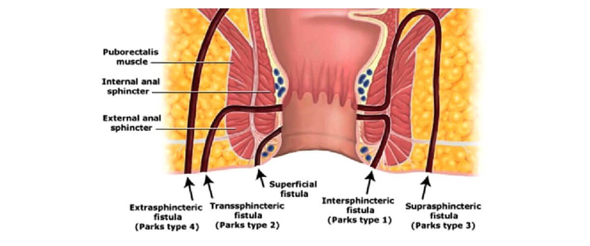 Which Is The Best Treatment For Fistula, And How Costly Is It?