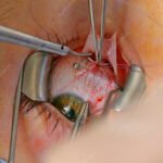 What Type of Cataract Surgery Do I Need