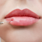 Myths About Dermal Fillers Debunked