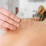 Acupuncture