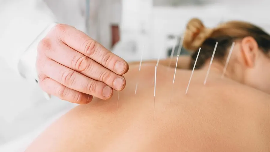 Harmony in Health: Exploring Acupuncture’s Impact in Sydney